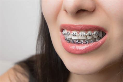 Cómo elegir tus brackets: metálicos o estéticos